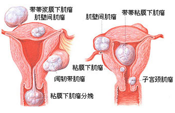 子宫肌瘤的原因是什么,怎么治疗子宫肌瘤