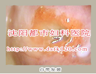 白带发黄有异味瘙痒是是怎么回事?沈阳铁西区妇婴医院医生谈白带异常的症状