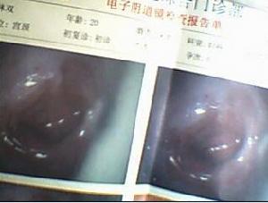 宫颈息肉检查