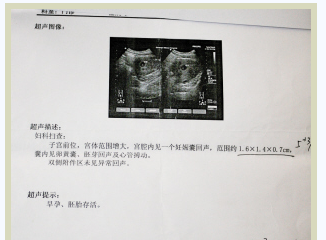 沈阳都市妇科医院早孕检查确定早孕B超单