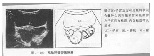 输卵管卵巢囊肿