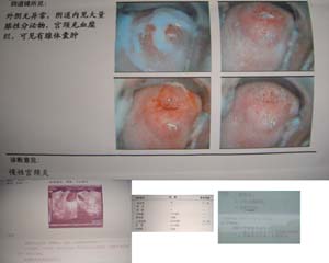 沈阳孟小姐盆腔积液超声CT单