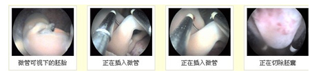 沈阳微管可视微痛人流过程