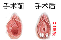 沈阳都市妇科医院2cm阴道紧缩术