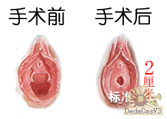 术前术后对比