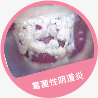 沈阳都市妇科医院医生谈霉菌性阴道炎症状图